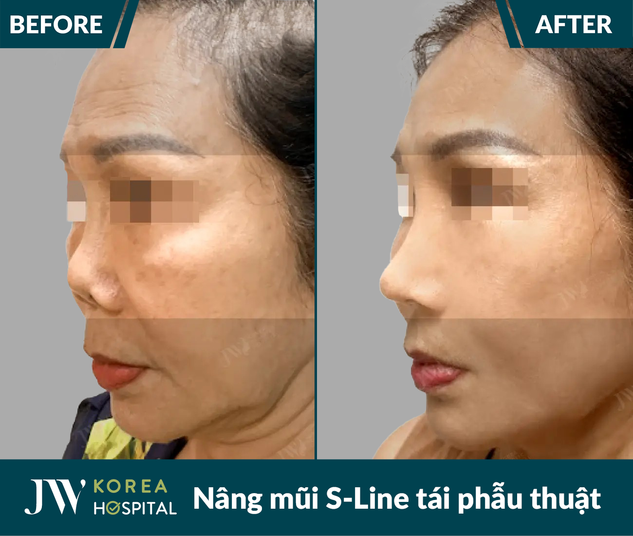 Tái phẫu thuật mũi lỗi