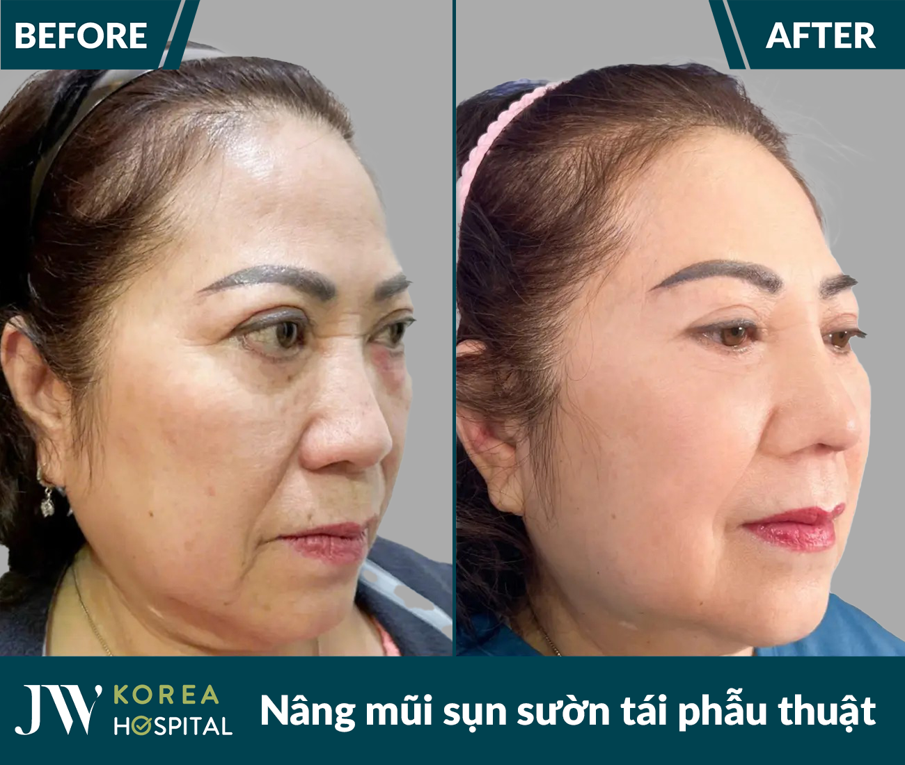 Tái phẫu thuật mũi lỗi