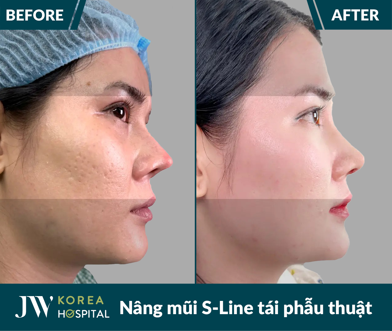 Tái phẫu thuật mũi lỗi