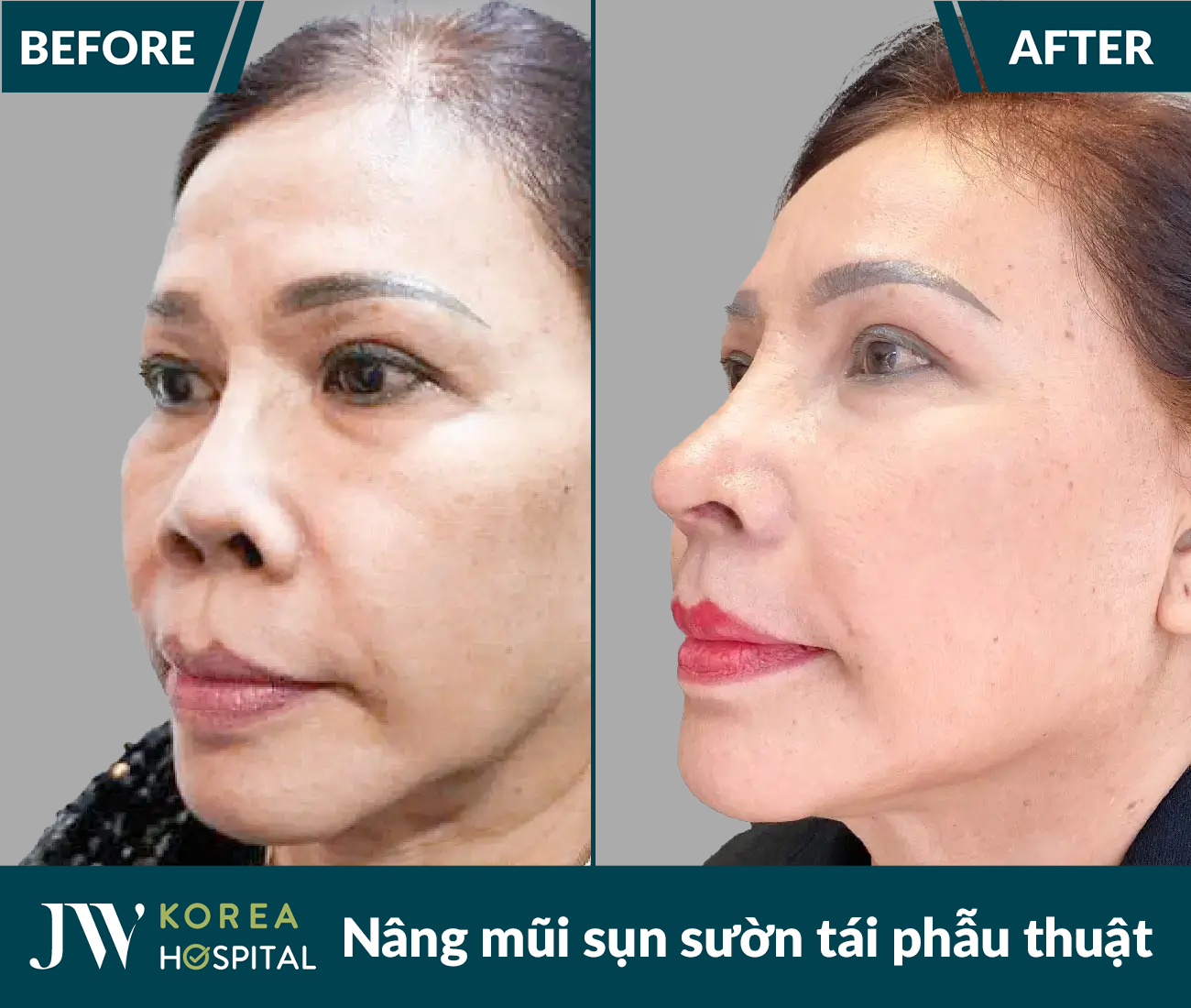 Tái phẫu thuật mũi lỗi