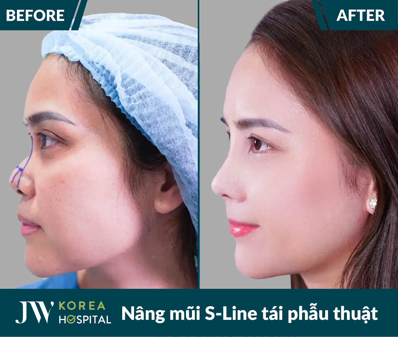 Tái phẫu thuật mũi lỗi