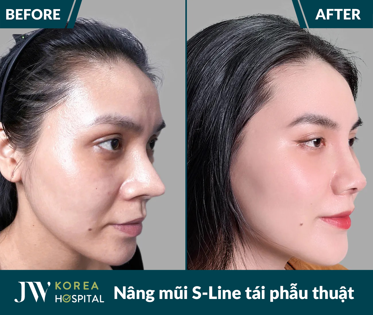 Tái phẫu thuật mũi lỗi