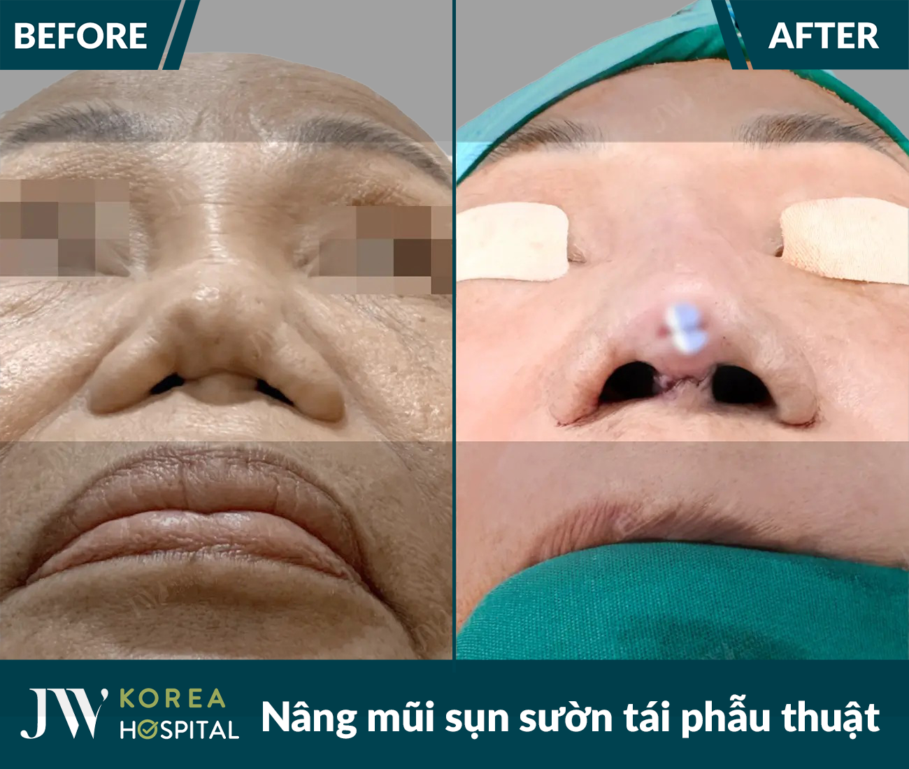 Tái phẫu thuật mũi lỗi