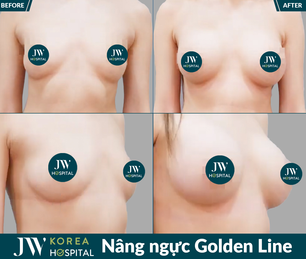 Nâng ngực thẩm mỹ