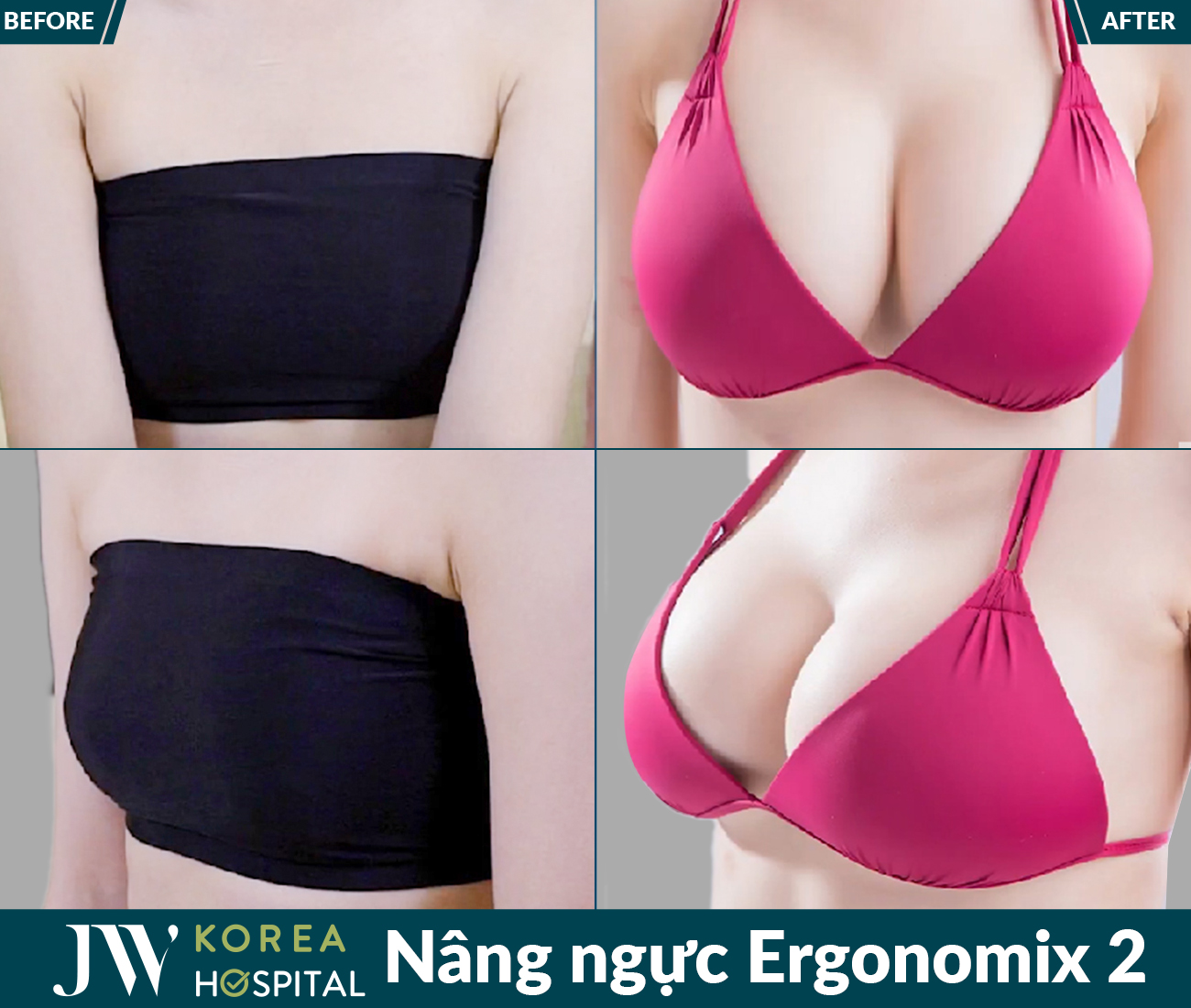 Nâng ngực thẩm mỹ