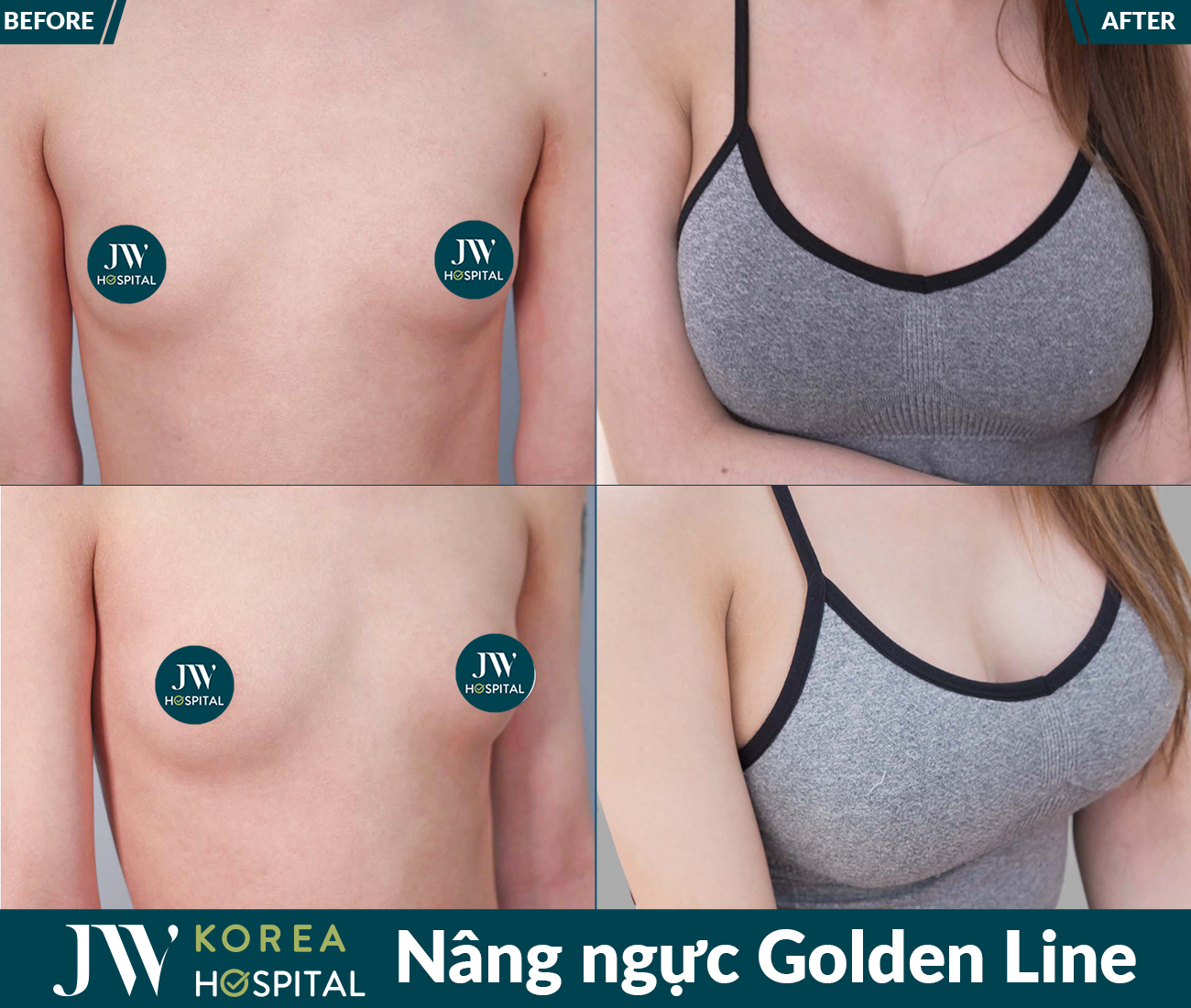 Nâng ngực thẩm mỹ