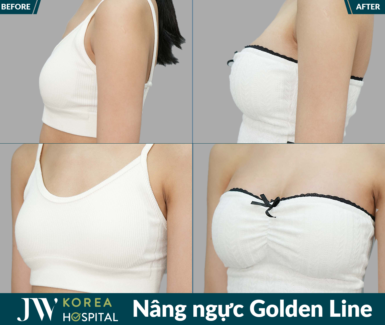 Nâng ngực thẩm mỹ