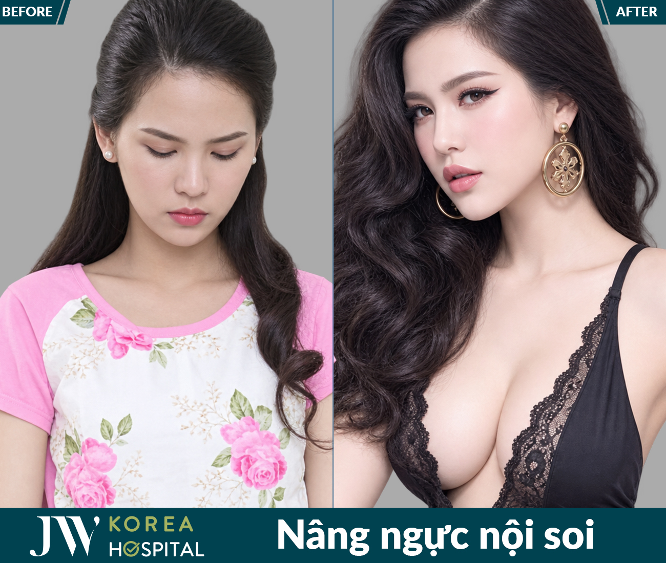 Nâng ngực thẩm mỹ