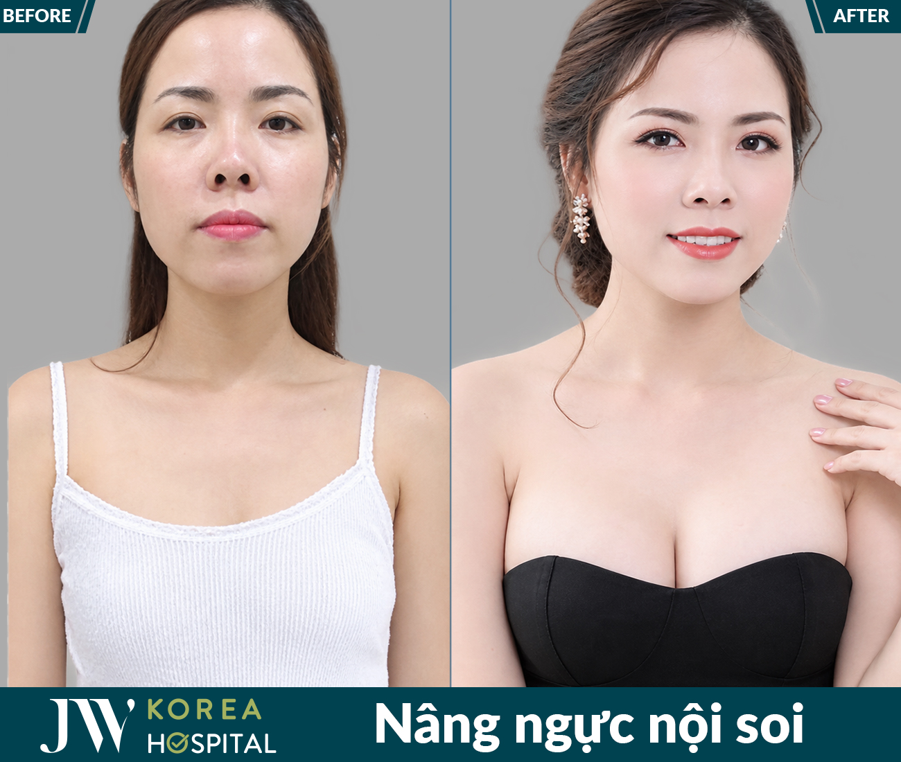 Nâng ngực thẩm mỹ
