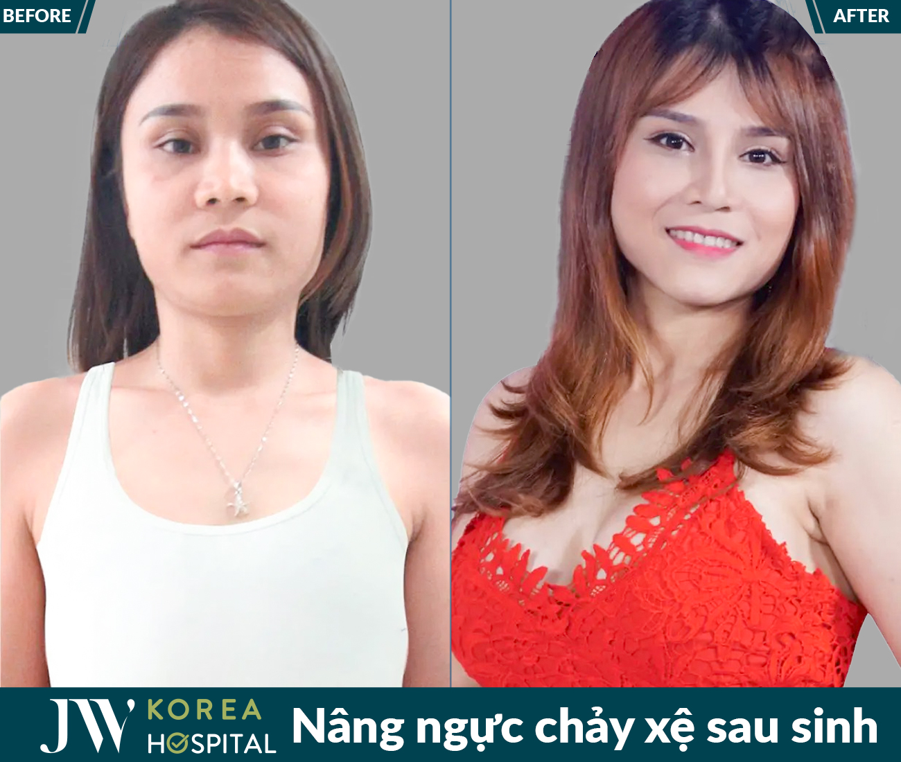 Nâng ngực thẩm mỹ
