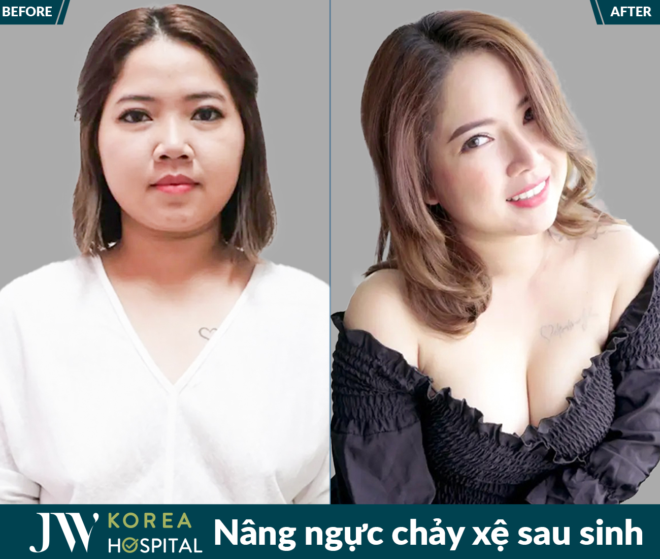 Nâng ngực thẩm mỹ