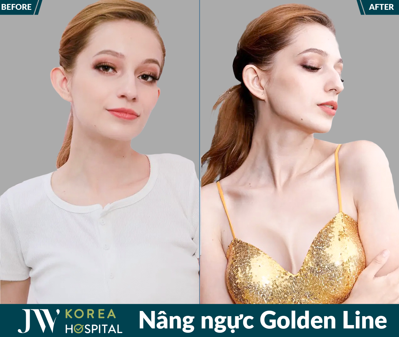 Nâng ngực thẩm mỹ