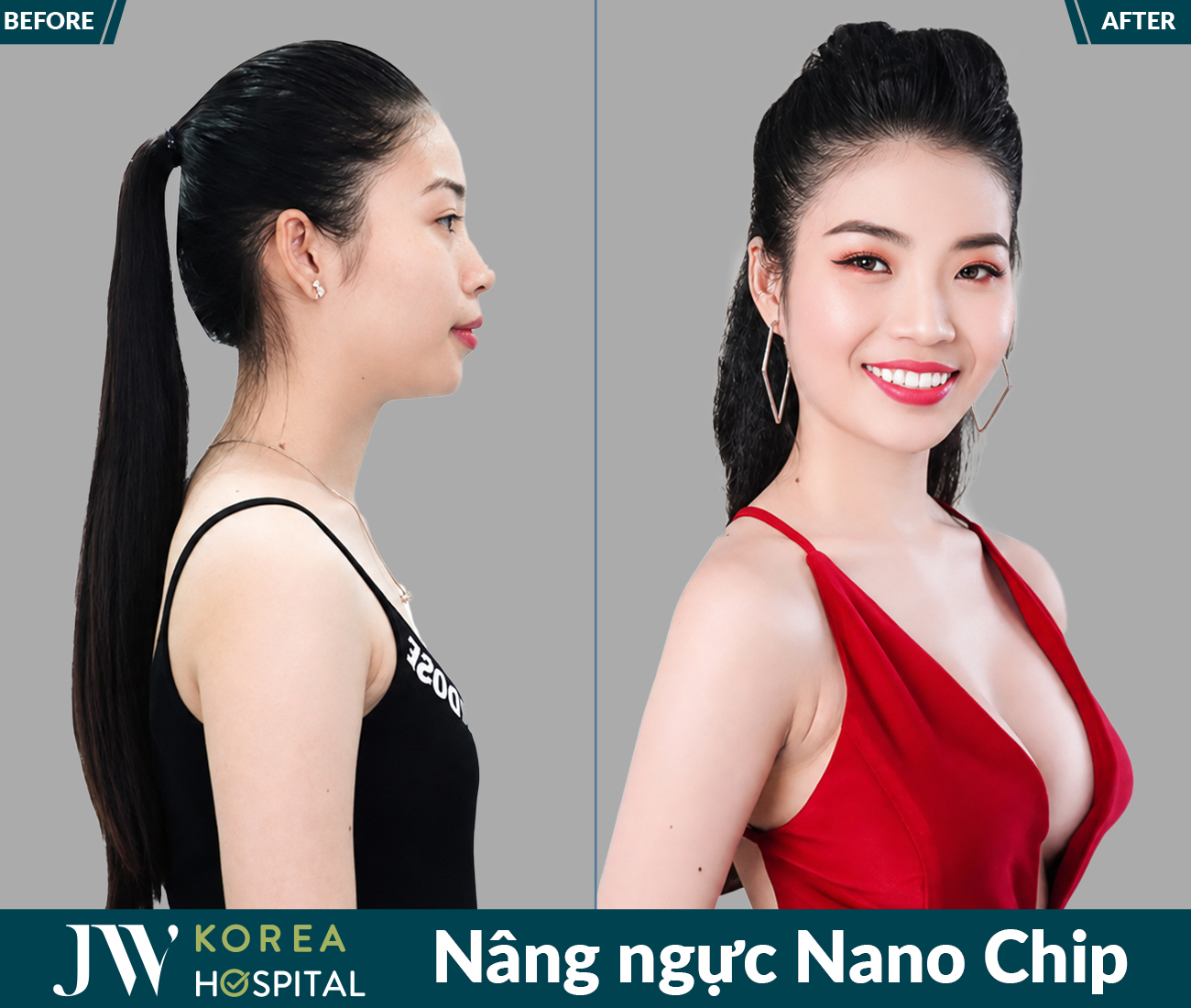 Nâng ngực thẩm mỹ