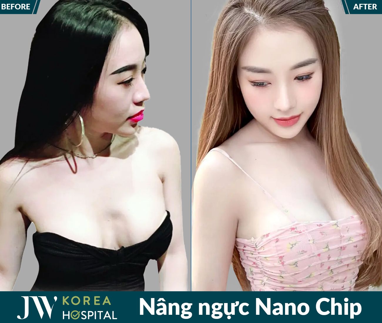 Nâng ngực thẩm mỹ