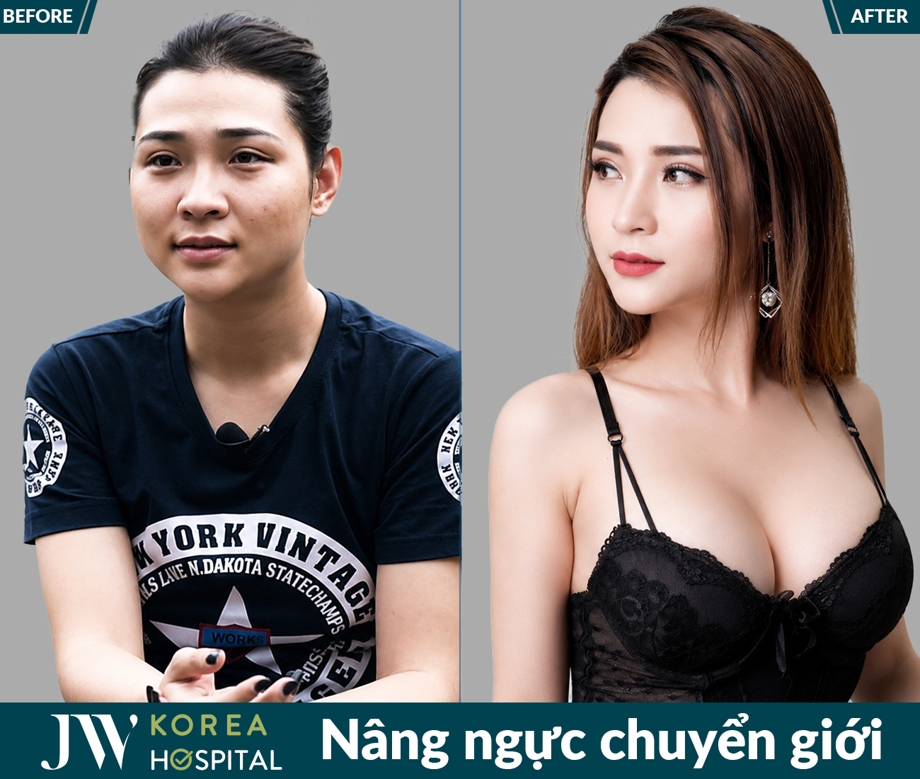 Nâng ngực thẩm mỹ