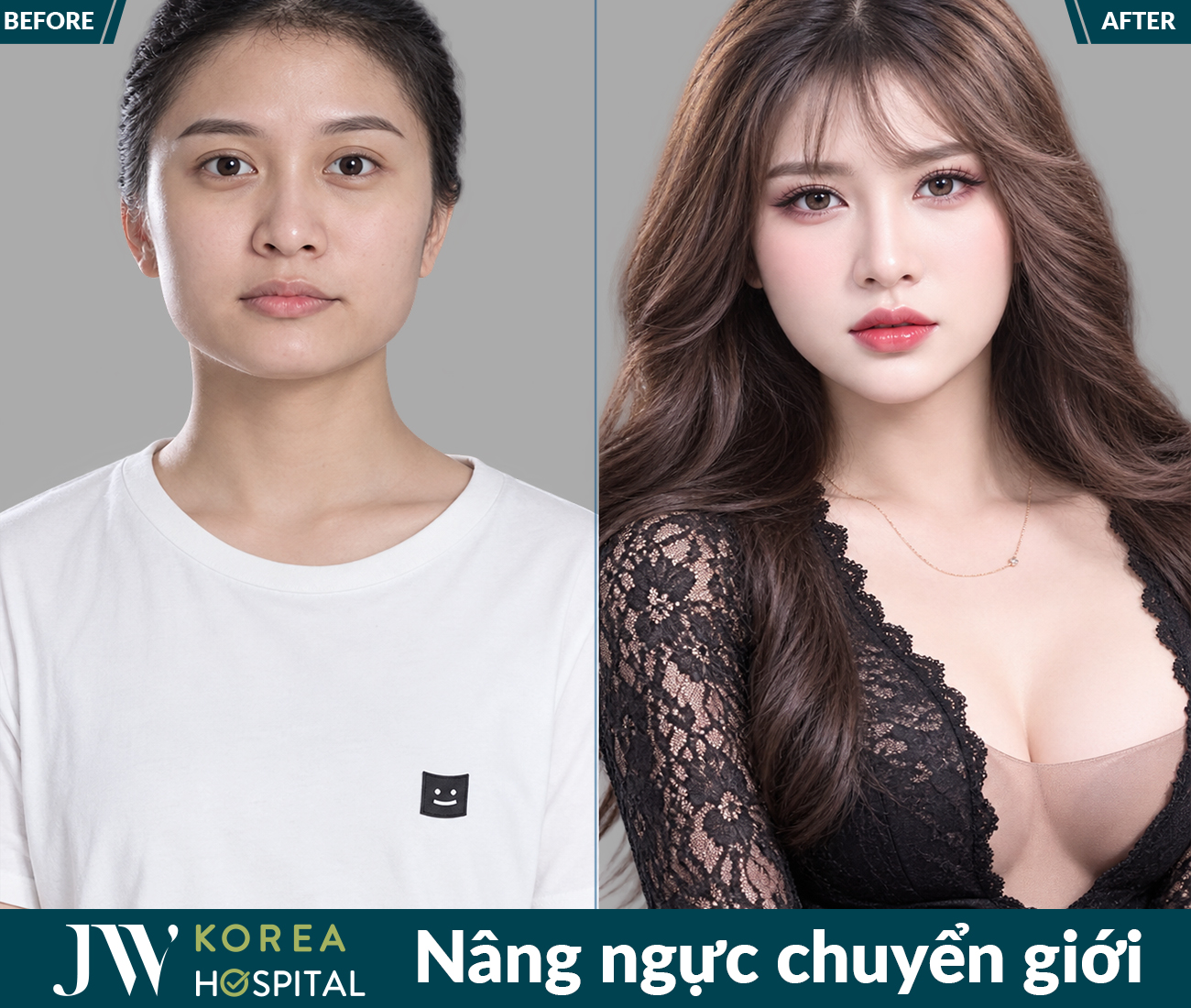 Nâng ngực thẩm mỹ