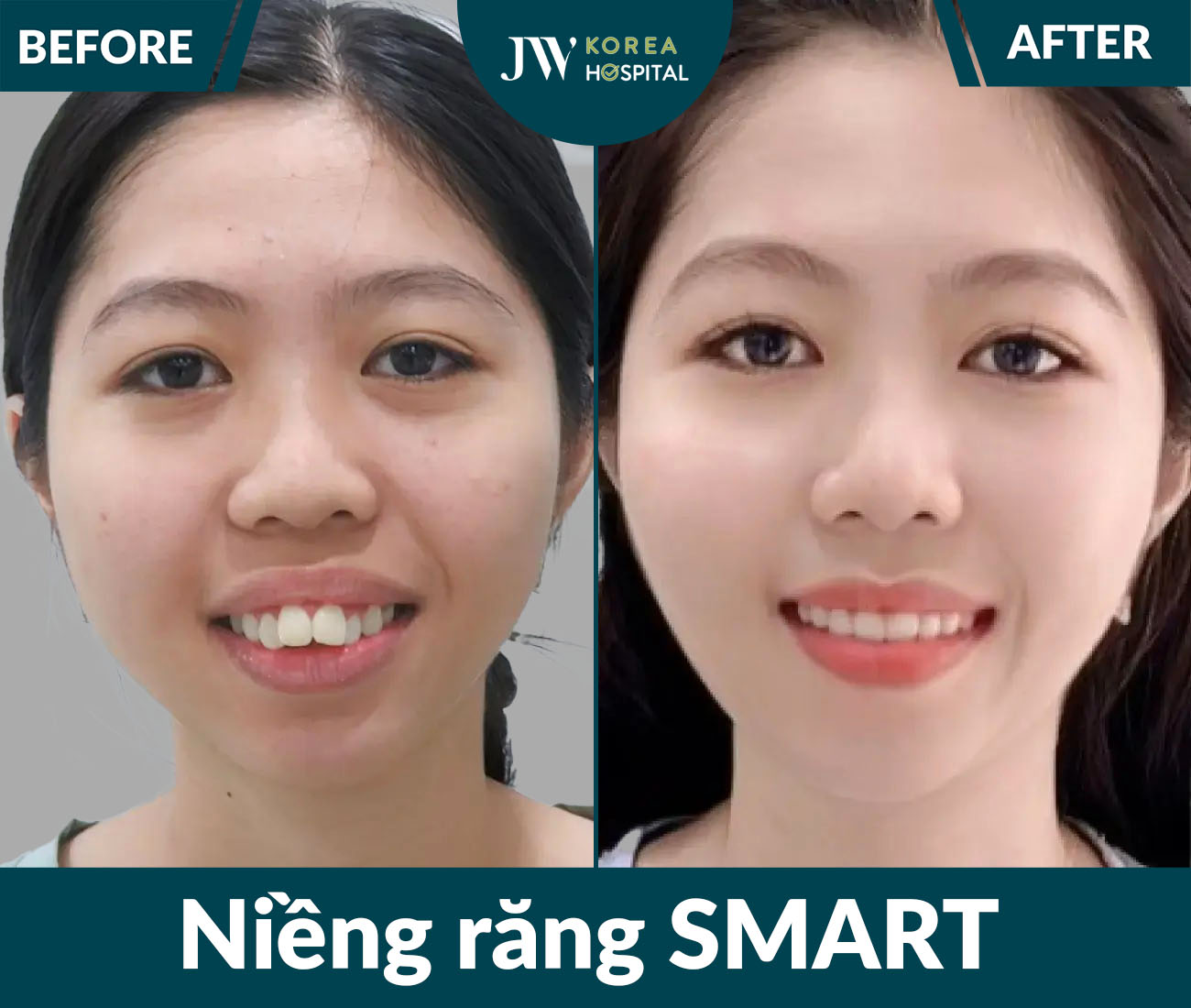Niềng răng SMART