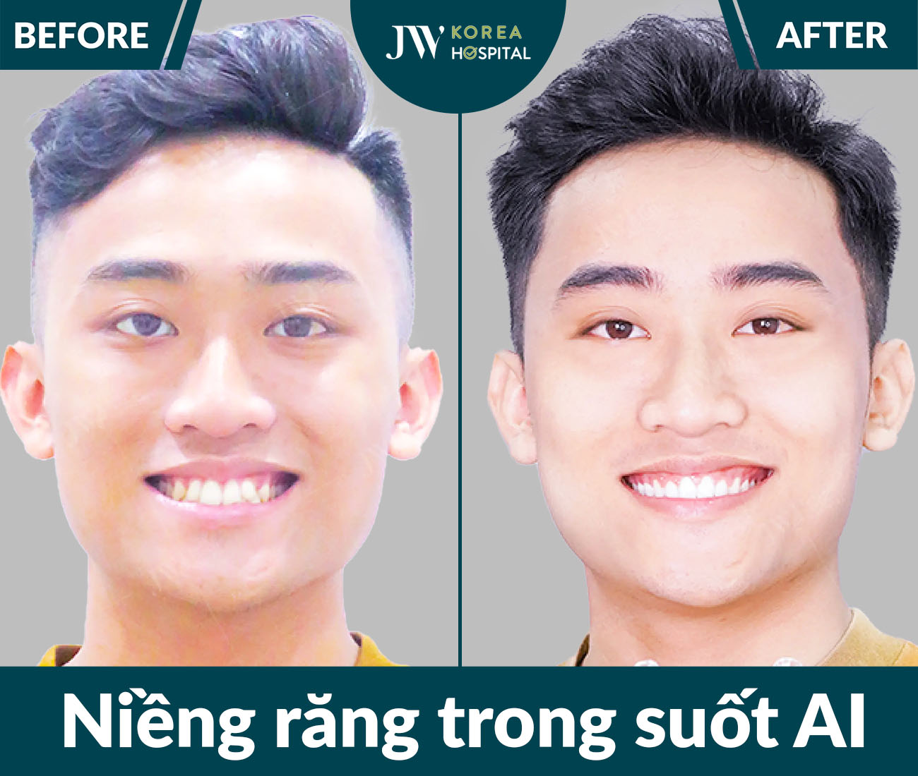 Niềng răng SMART