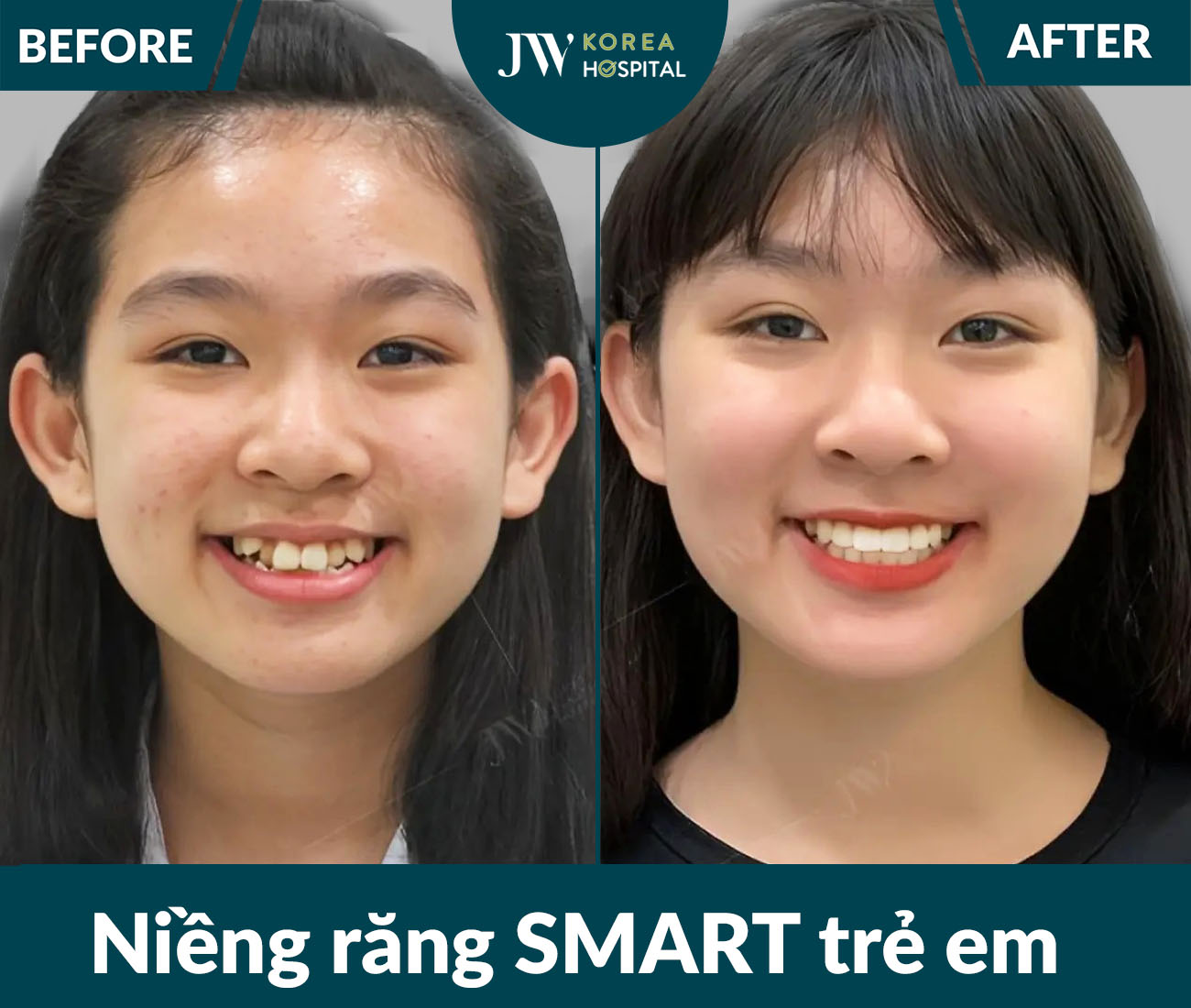 Niềng răng SMART