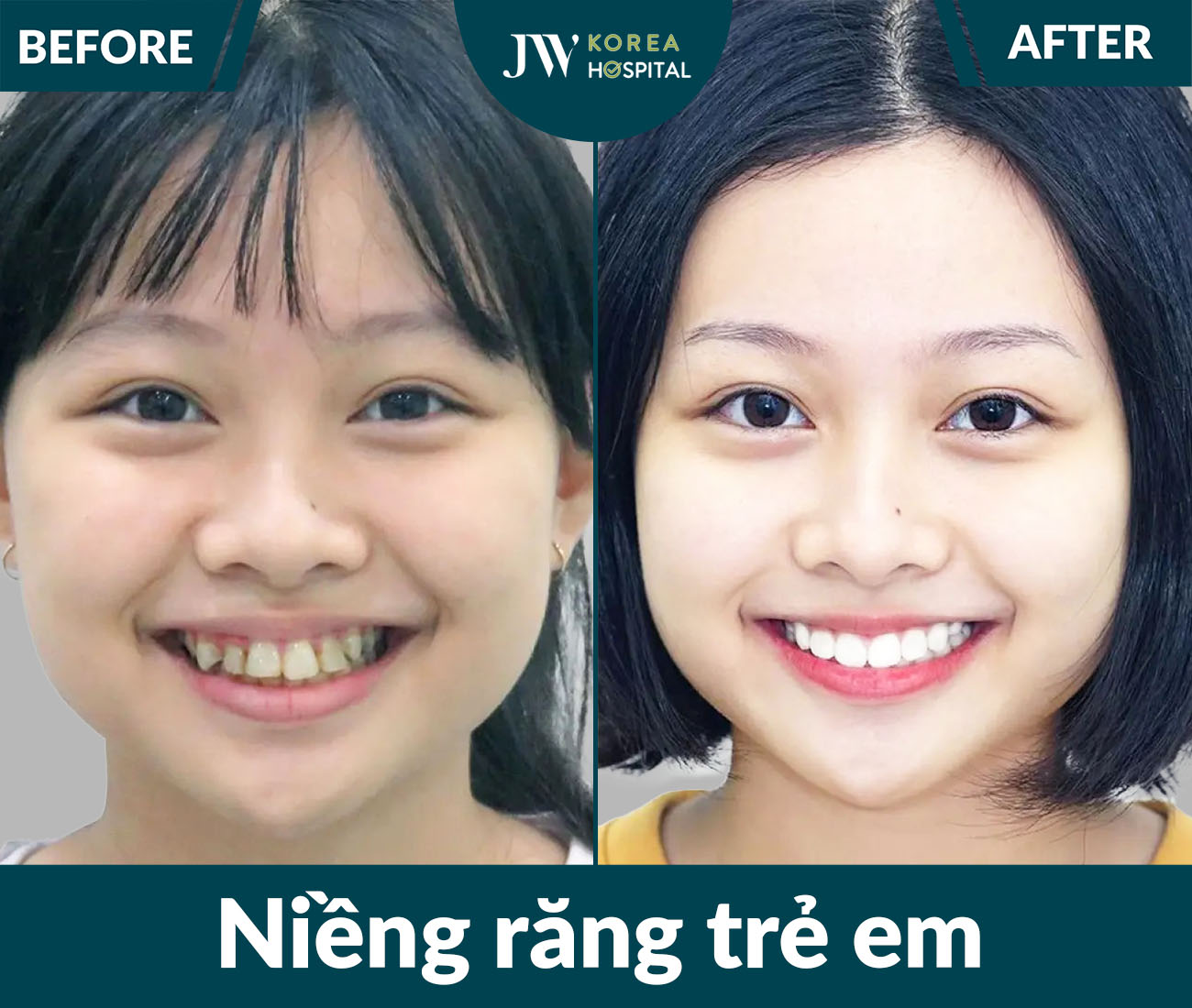 Niềng răng SMART