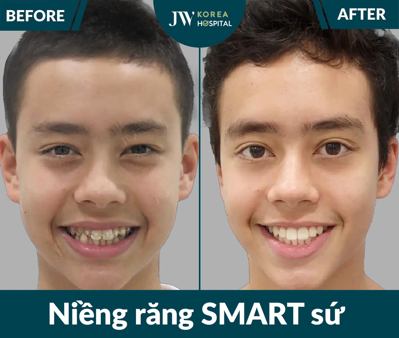 Niềng răng SMART