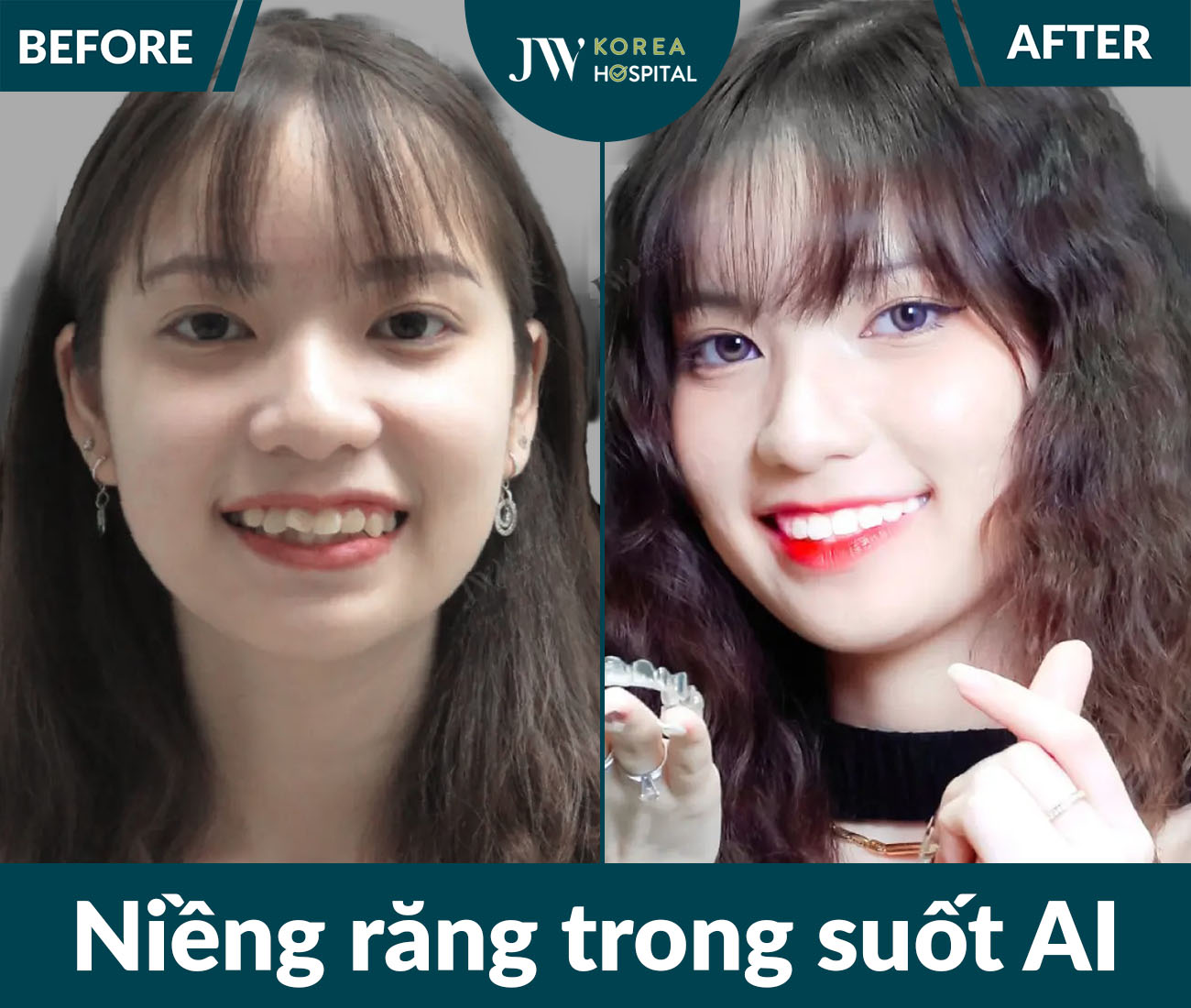 Niềng răng SMART