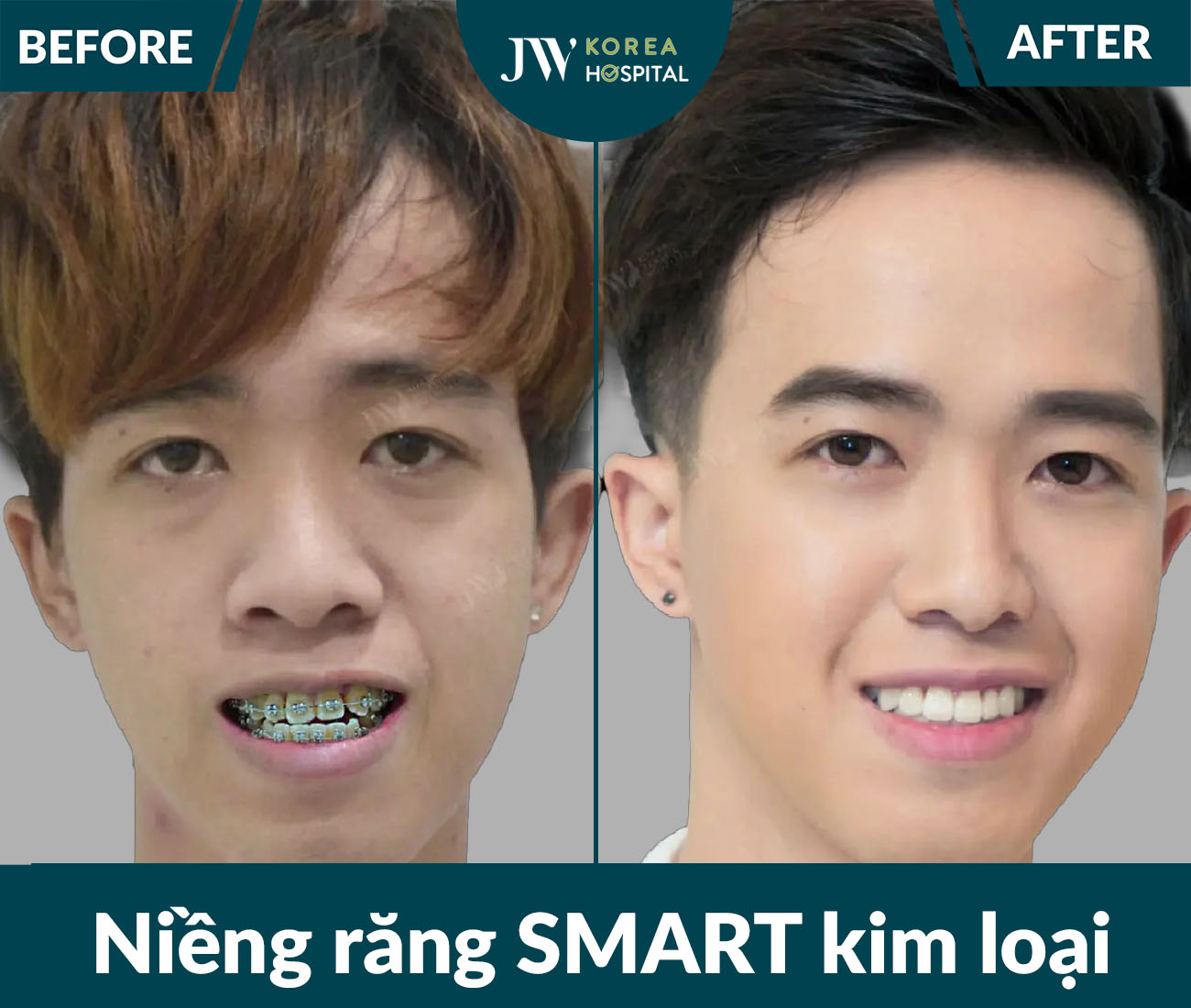 Niềng răng SMART