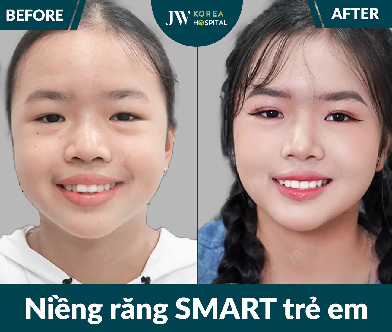Niềng răng SMART