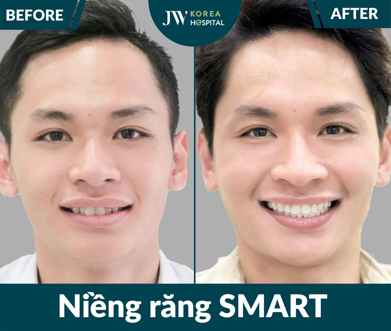 Niềng răng SMART
