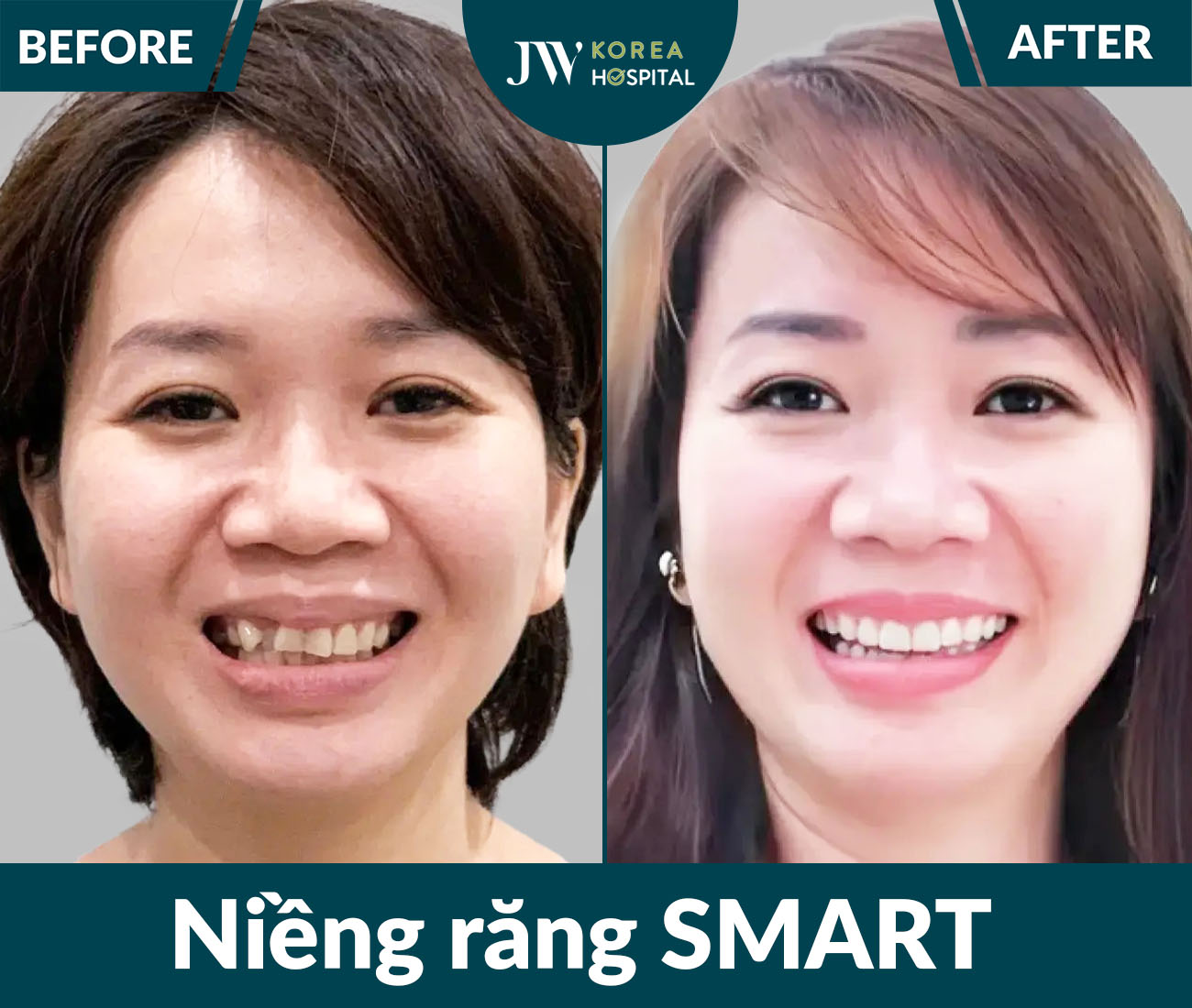 Niềng răng SMART
