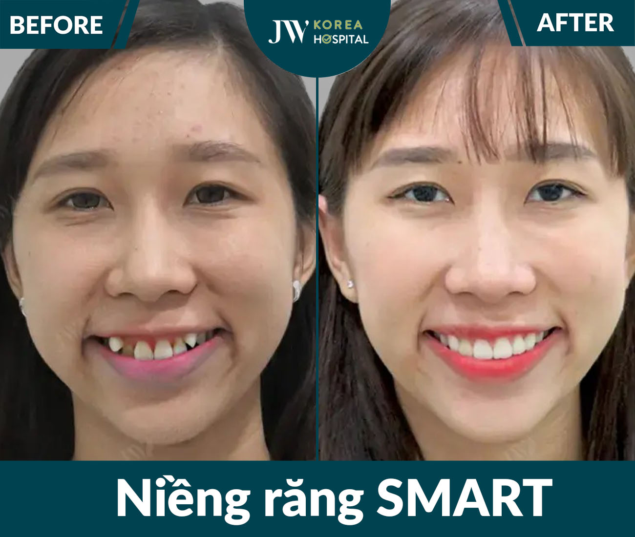 Niềng răng SMART