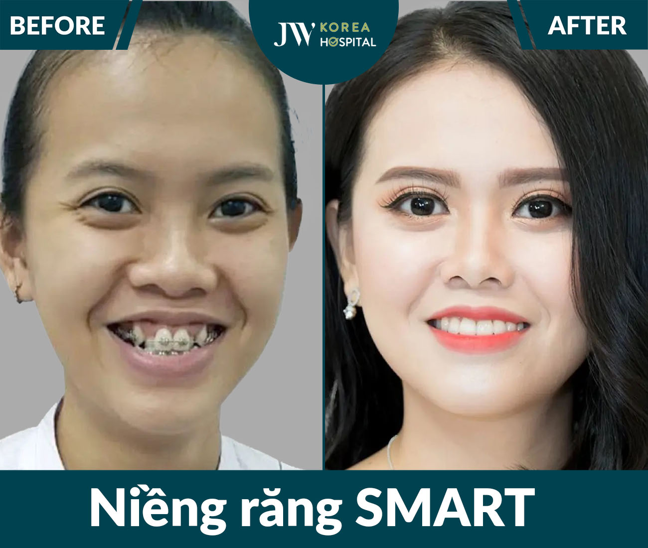 Niềng răng SMART
