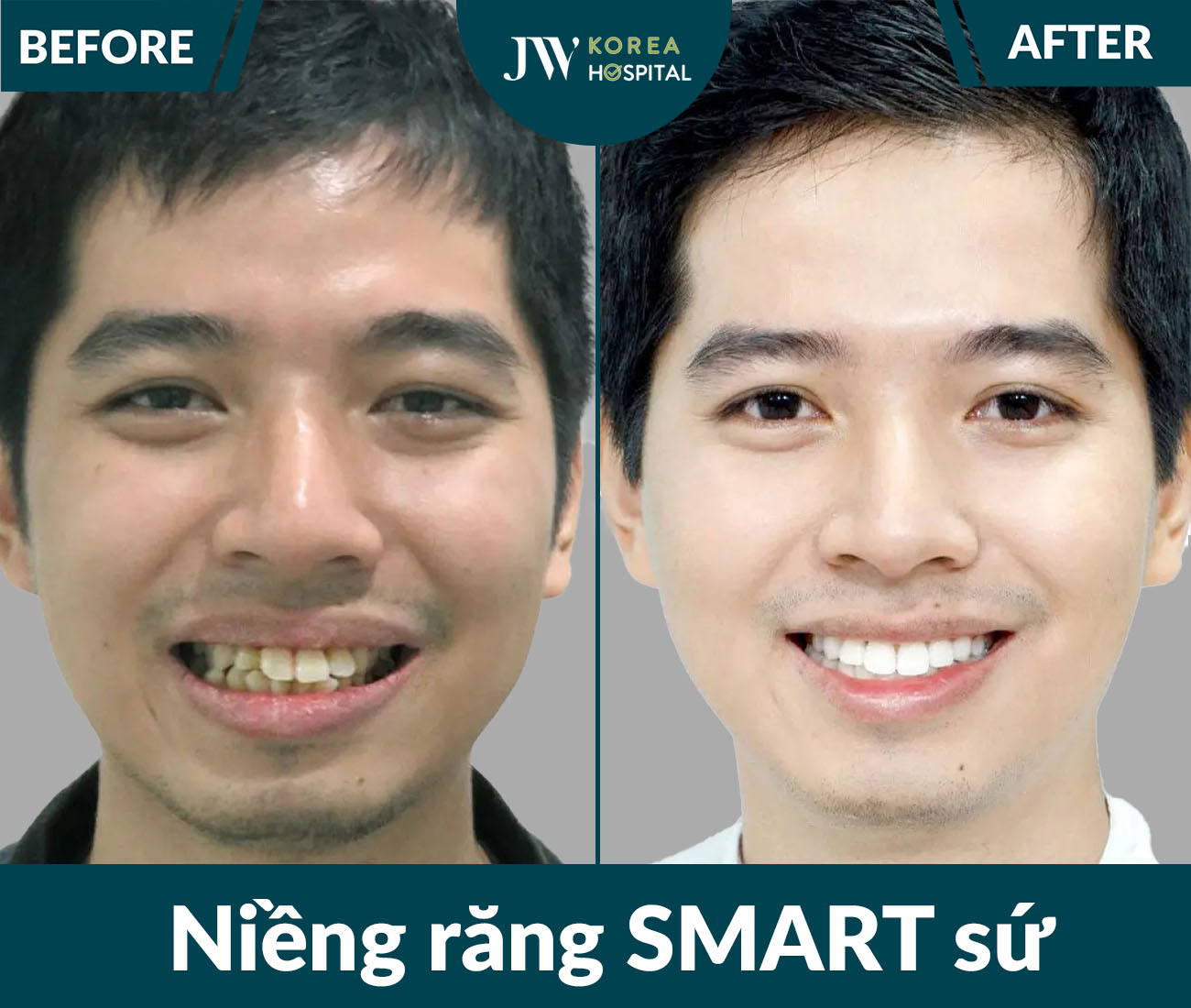 Niềng răng SMART