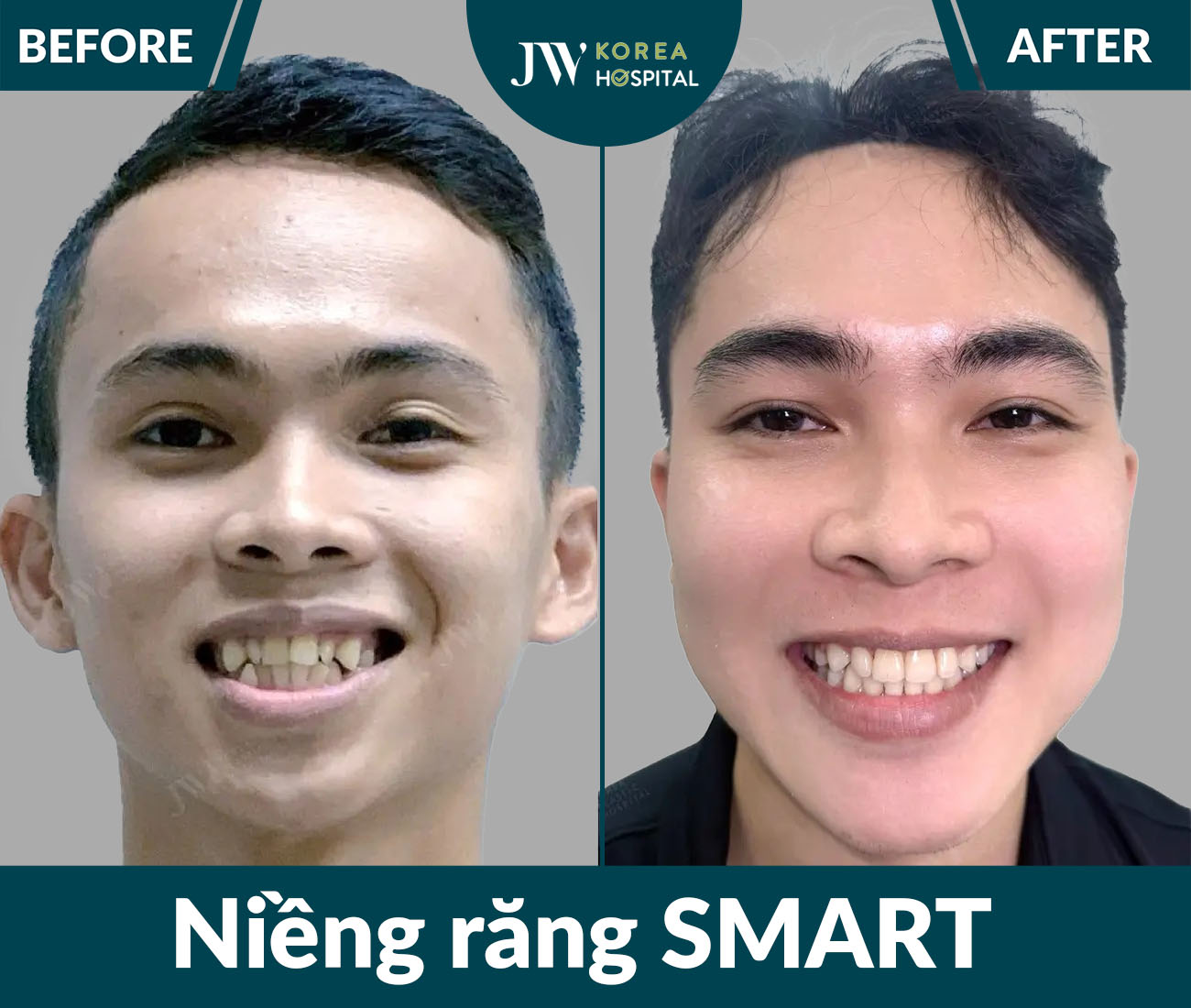 Niềng răng SMART