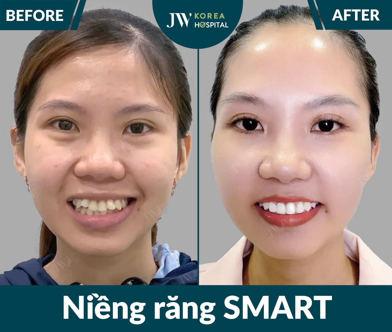 Niềng răng SMART