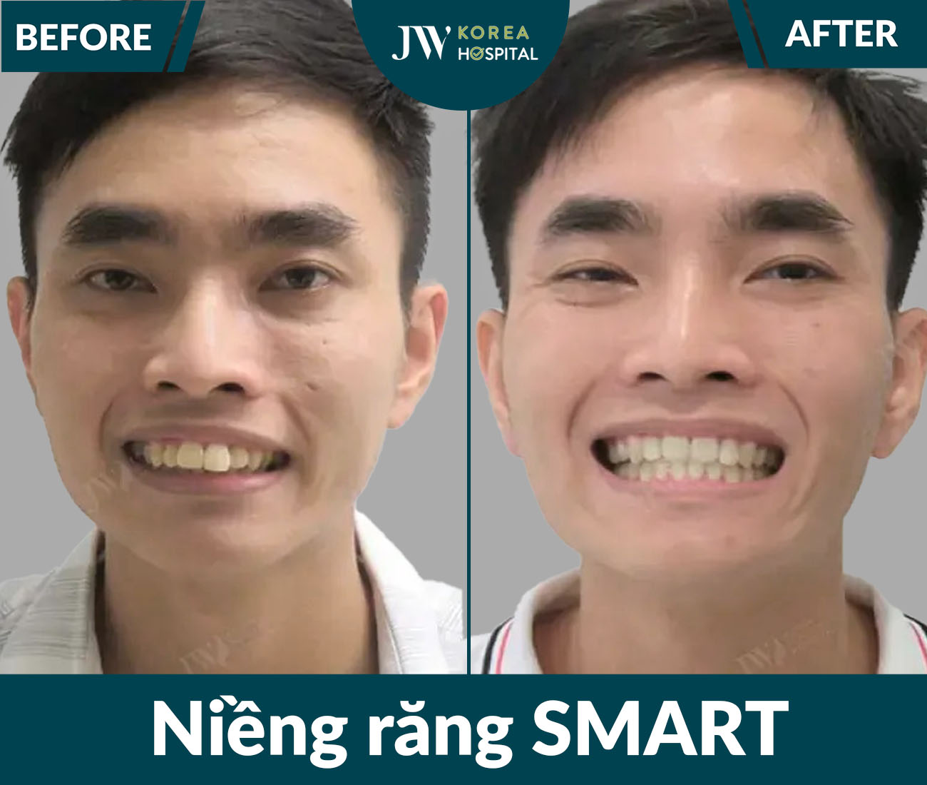 Niềng răng SMART