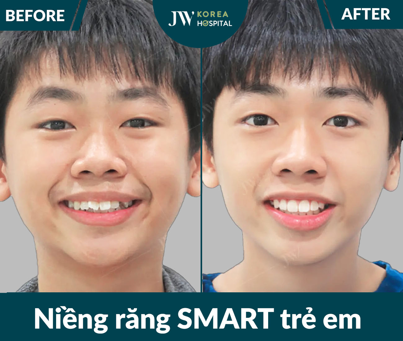 Niềng răng SMART