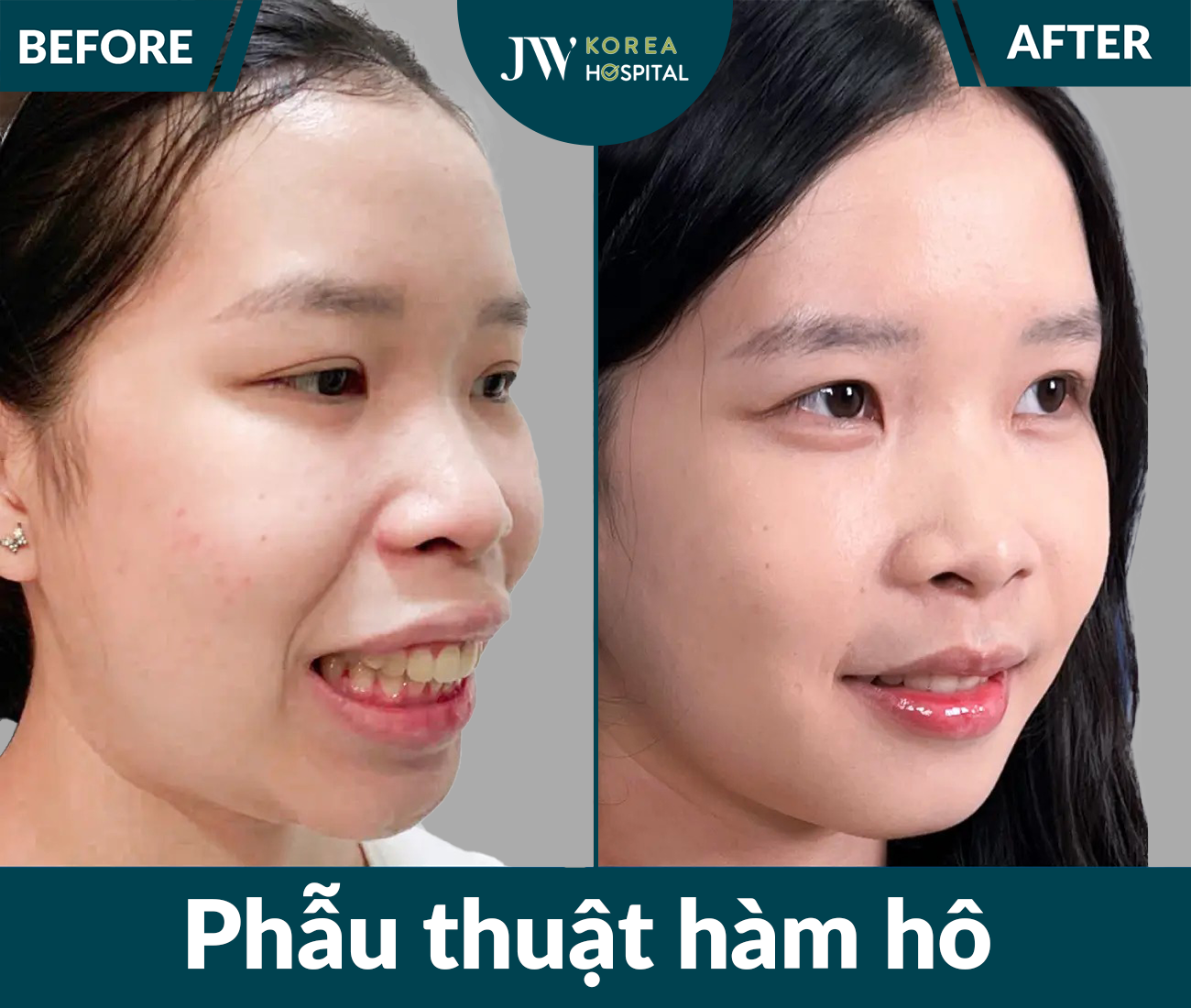 Phẫu thuật hàm hô
