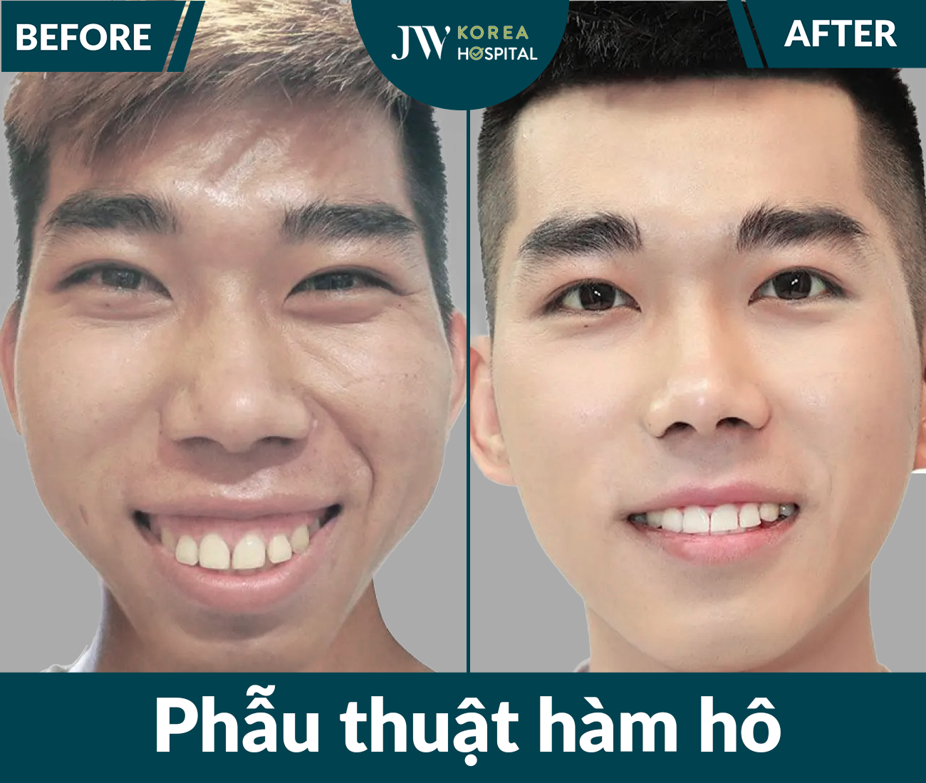 Phẫu thuật hàm hô