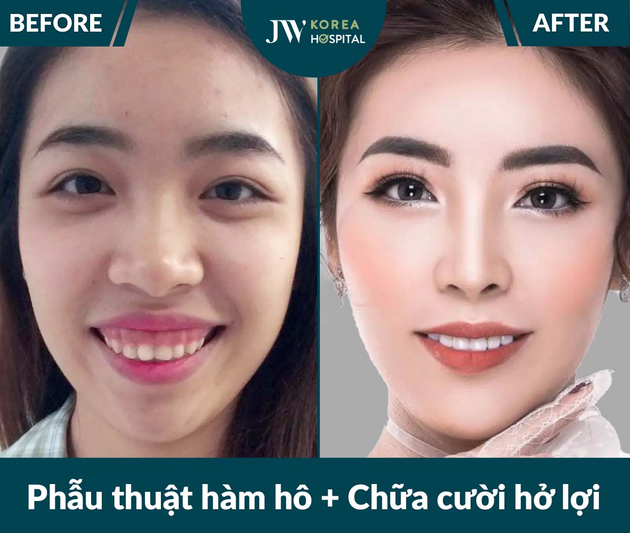 Phẫu thuật hàm hô