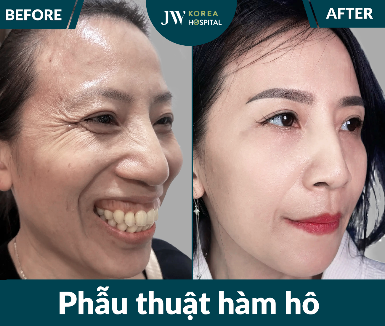 Phẫu thuật hàm hô