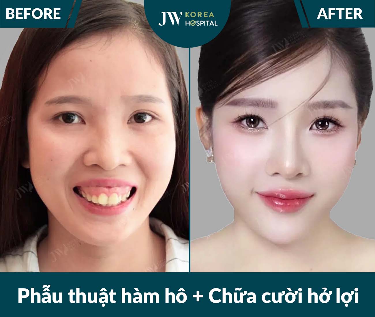 Phẫu thuật hàm hô