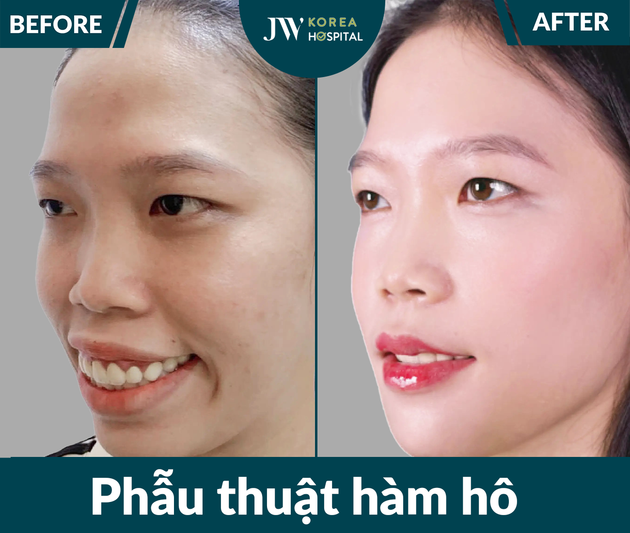 Phẫu thuật hàm hô
