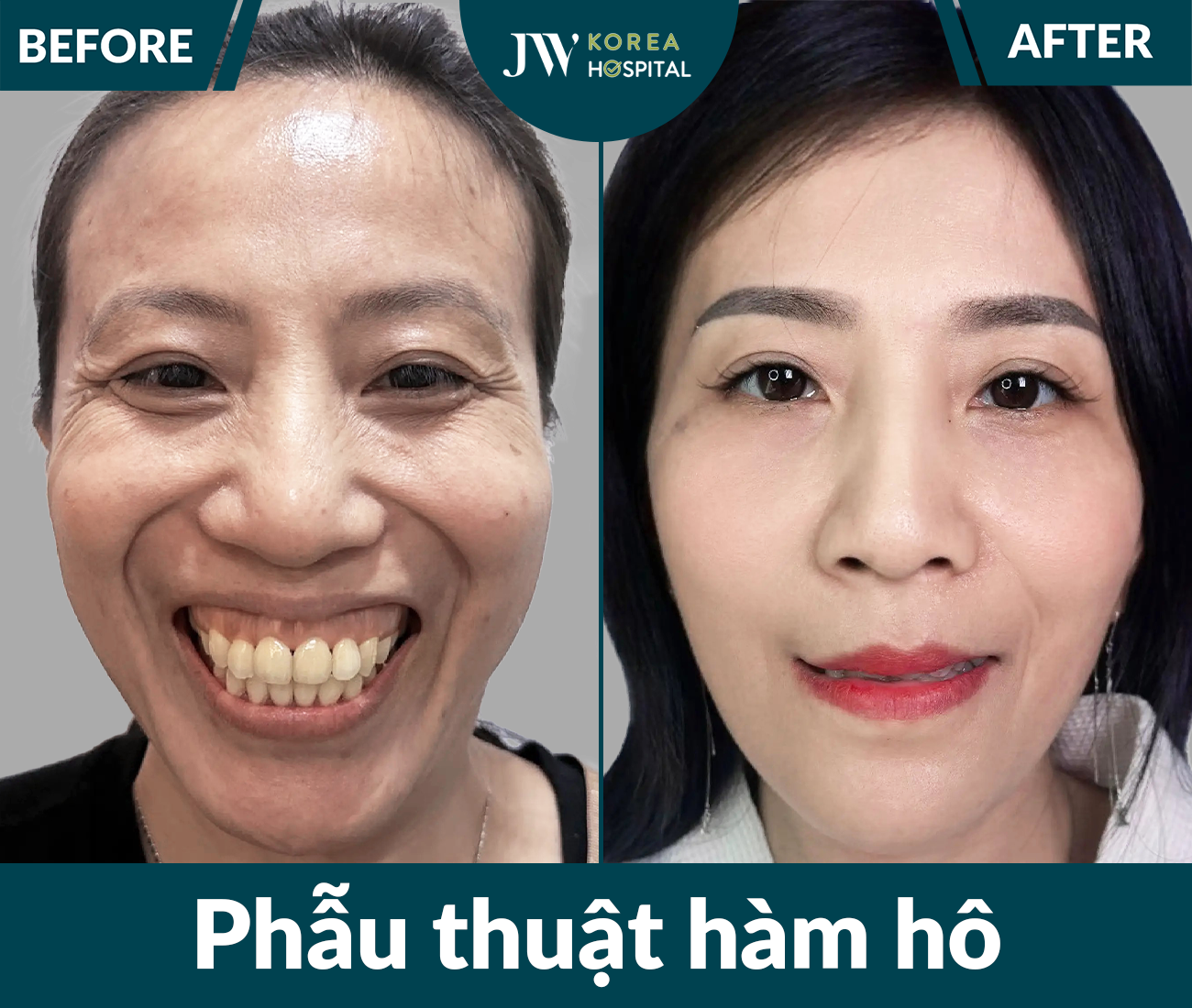 Phẫu thuật hàm hô