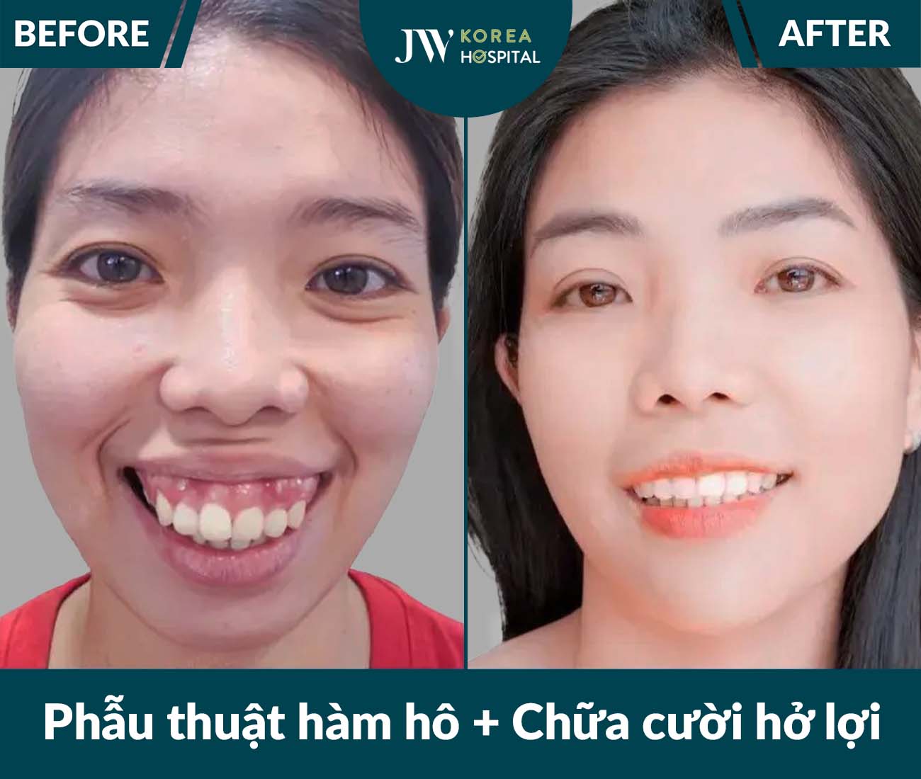 Phẫu thuật hàm hô