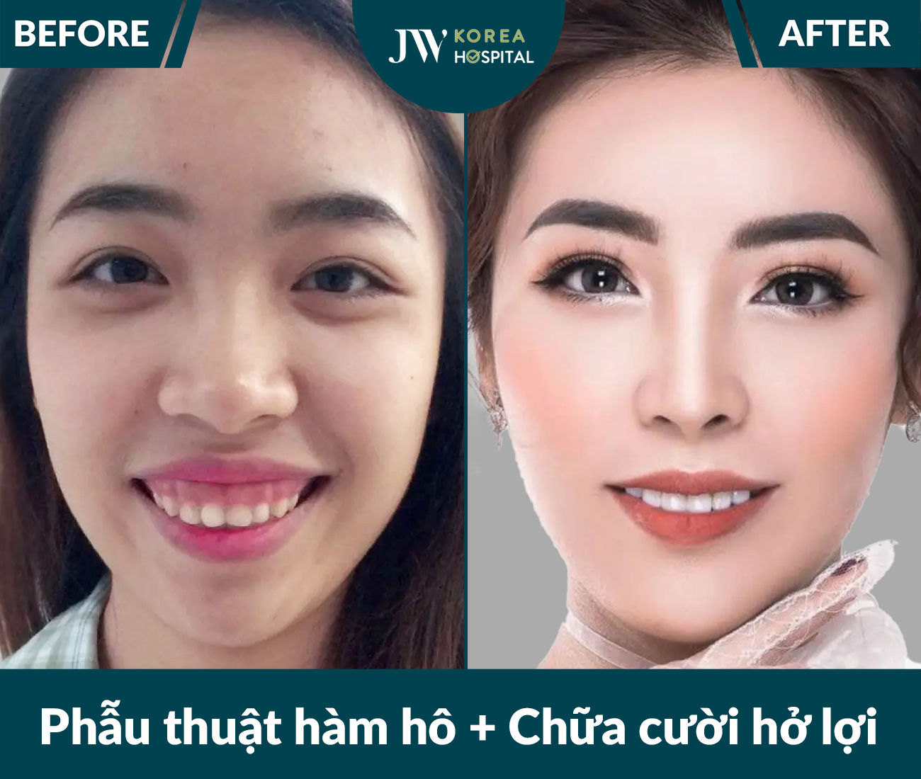 Phẫu thuật hàm hô