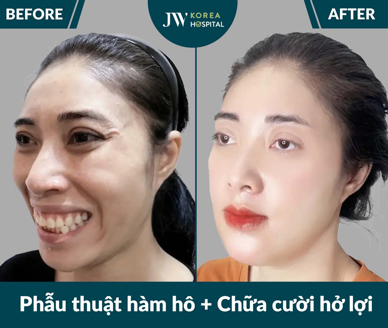 Phẫu thuật hàm hô