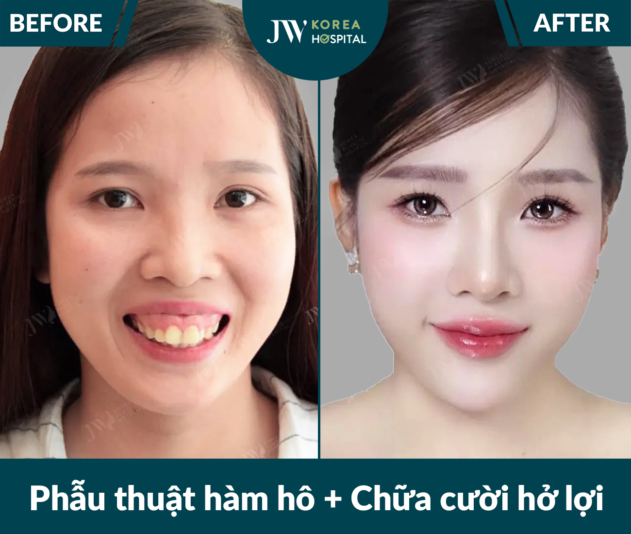 Phẫu thuật hàm hô