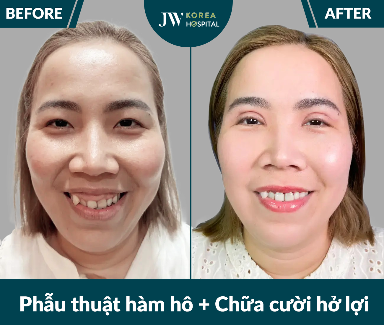 Phẫu thuật hàm hô