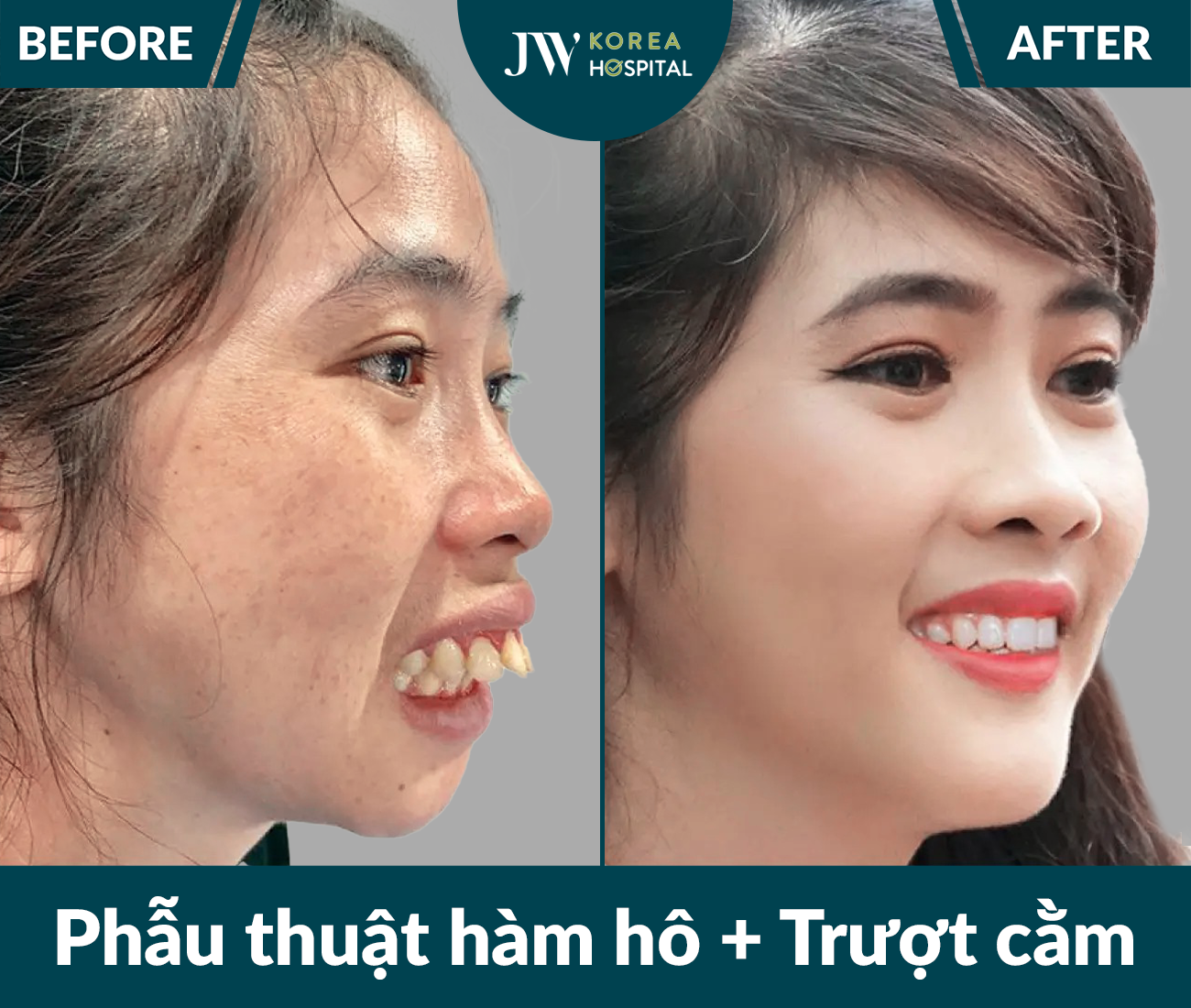 Phẫu thuật hàm hô